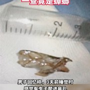 男子睡梦中蟑螂从鼻孔呛进气管：受刺激后开始咳嗽